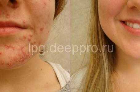 фото до и после лечения акне