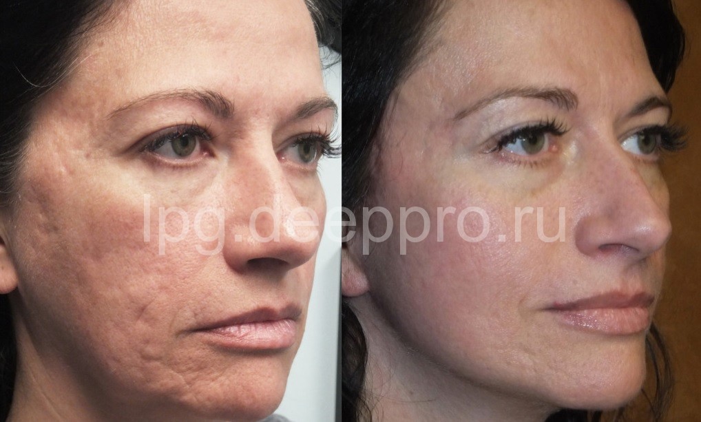 Фото до и после лечения 